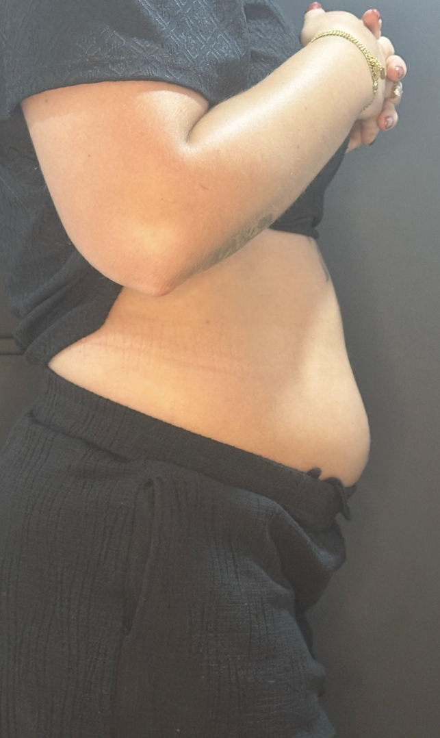 EMShape buik na 5 behandelingen