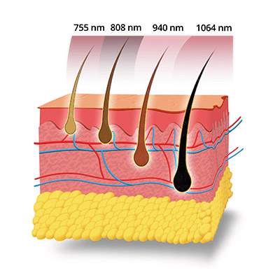 Golflengten diode laser