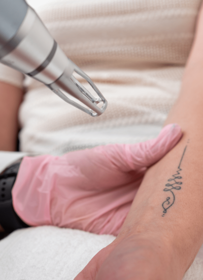 Tattoo removal
